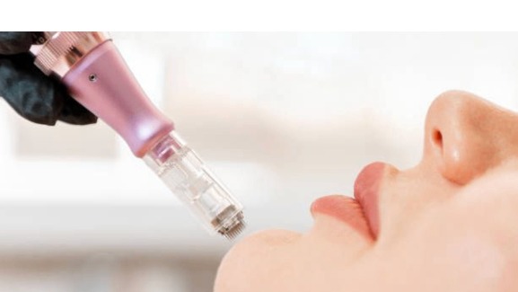 Microneedling treatment results